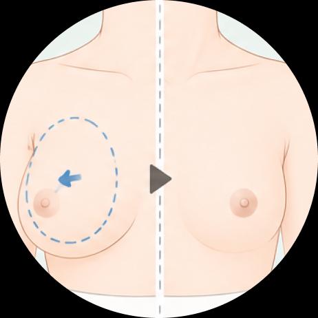 การรักษาภาวะเต้านมโตในผู้ชาย (Gynecomastia)