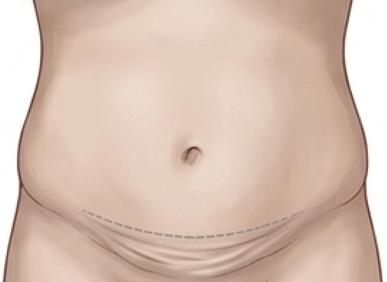 Abdominoplasty