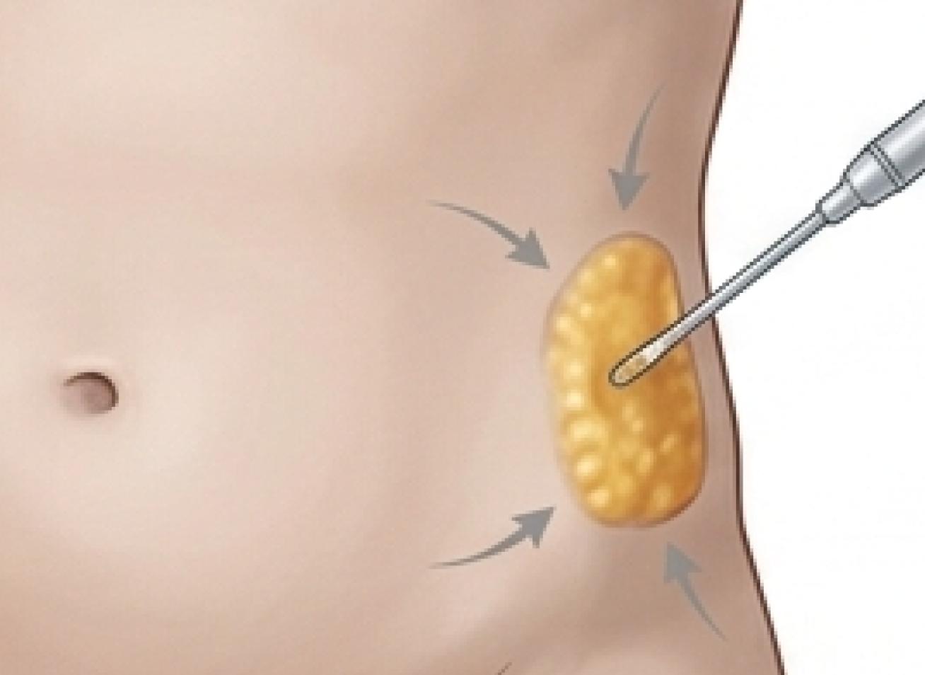 Mini Liposuction