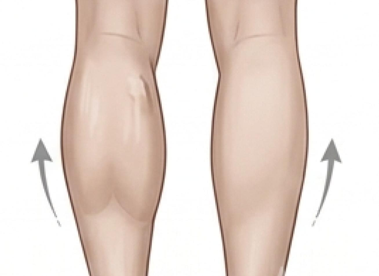 Calf Muscle Botox