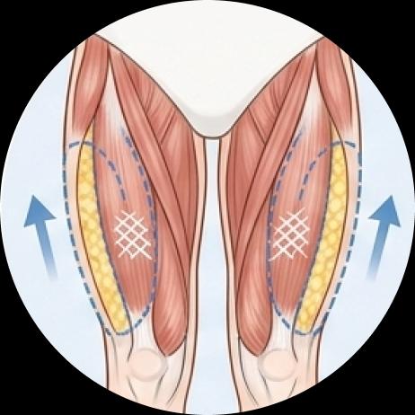 Thigh Liposuction