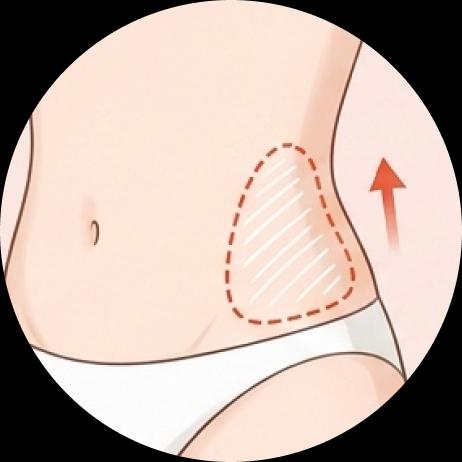 Mini Liposuction