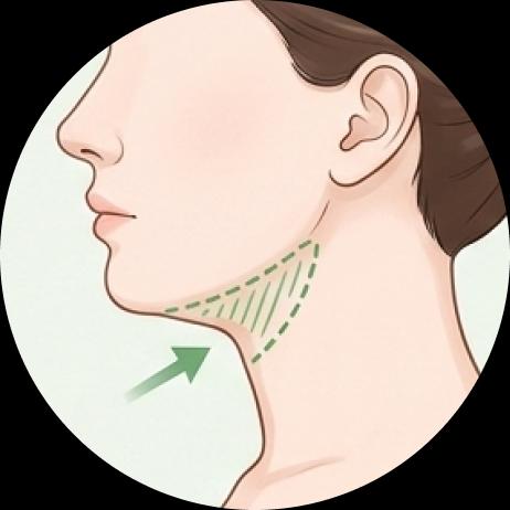 Chin Mini Liposuction