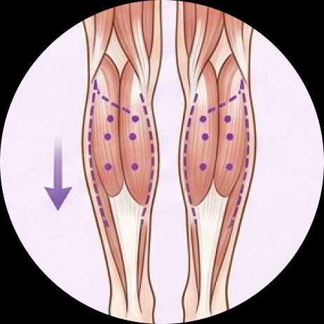 Calf Muscle Botox