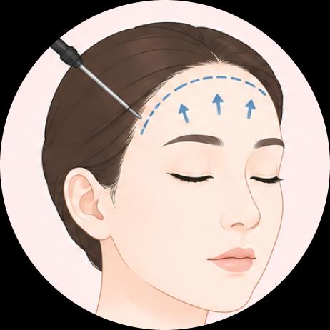 การยกคิ้วด้วยกล้องส่อง (Endotine Fixation)