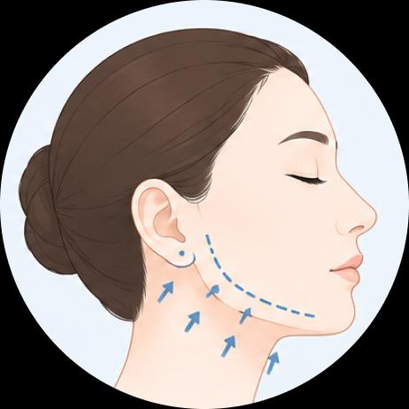 การยกกระชับส่วนล่างของใบหน้าและลำคอ, Deep Plane Face Lift; ยกกระชับชั้นลึกใต้ SMAS (Lower Face & Neck lift)