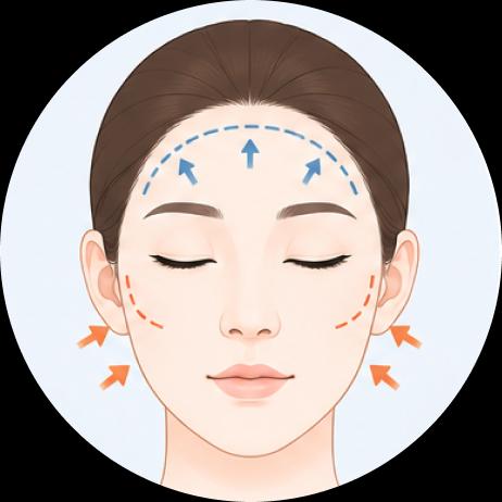 Malar Reduction and Forehead Augmentation