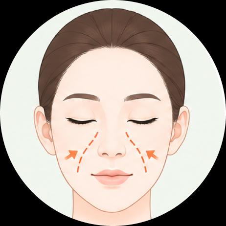 Paramaxilla Augmentation (Cheekbone Augmentation)