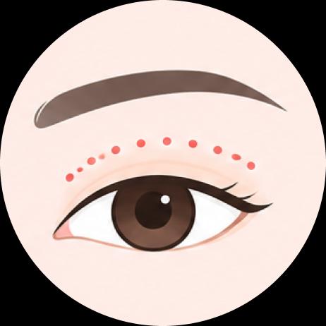 Metode Jahitan Kelopak Mata Atas (Suture Method for Double Eyelid)