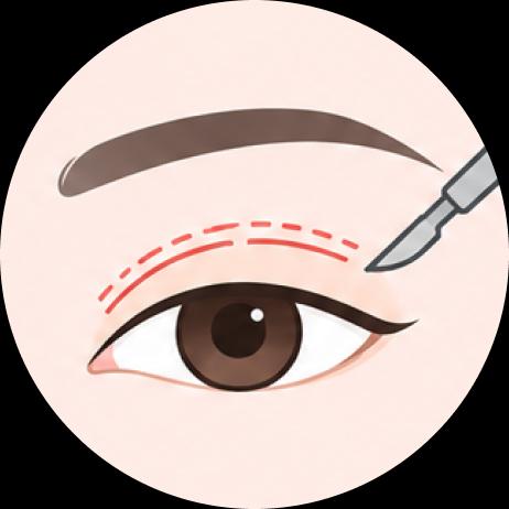 Metode Insisi Kelopak Mata Atas (Incision Method for Double Eyelid)
