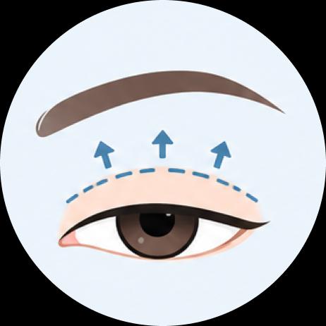 Operasi Ptosis, Koreksi Bentuk Mata (Ptosis Surgery)