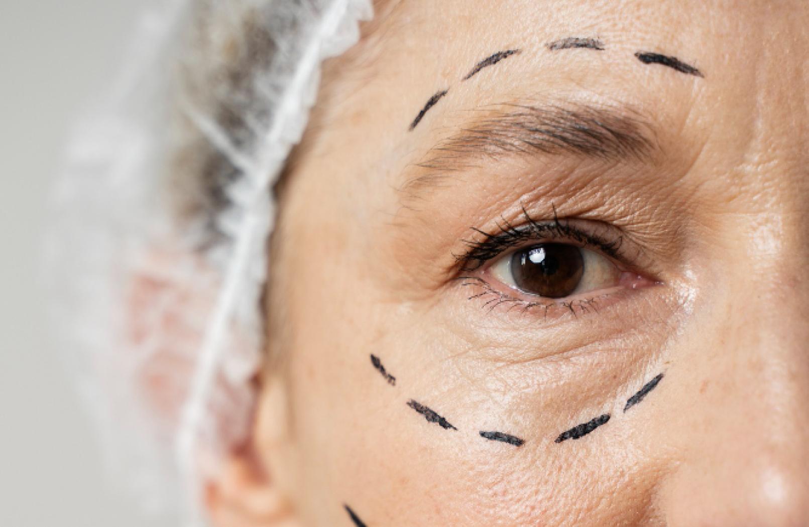 Eyelid Surgery