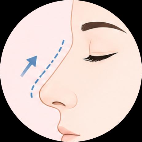 Aumento de puente nasal bajo (In case of Low Dorsum)