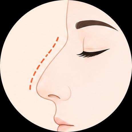 Corrección de nariz aguileña (The correction of Hump Nose)