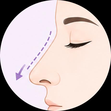Corrección de nariz respingona (The correction of Arrowed Nose)