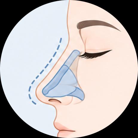 Nariz en silla debido a resección excesiva del tabique nasal, Reconstrucción del tabique nasal con cartílago costal (Saddle Nose due to overresection of nasal septum)