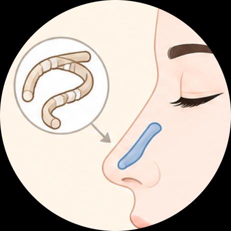 Nariz contraída, Reconstrucción nasal con cartílago costal (Nose Contracture; Nasal tip reconstruction using rib cartilage)