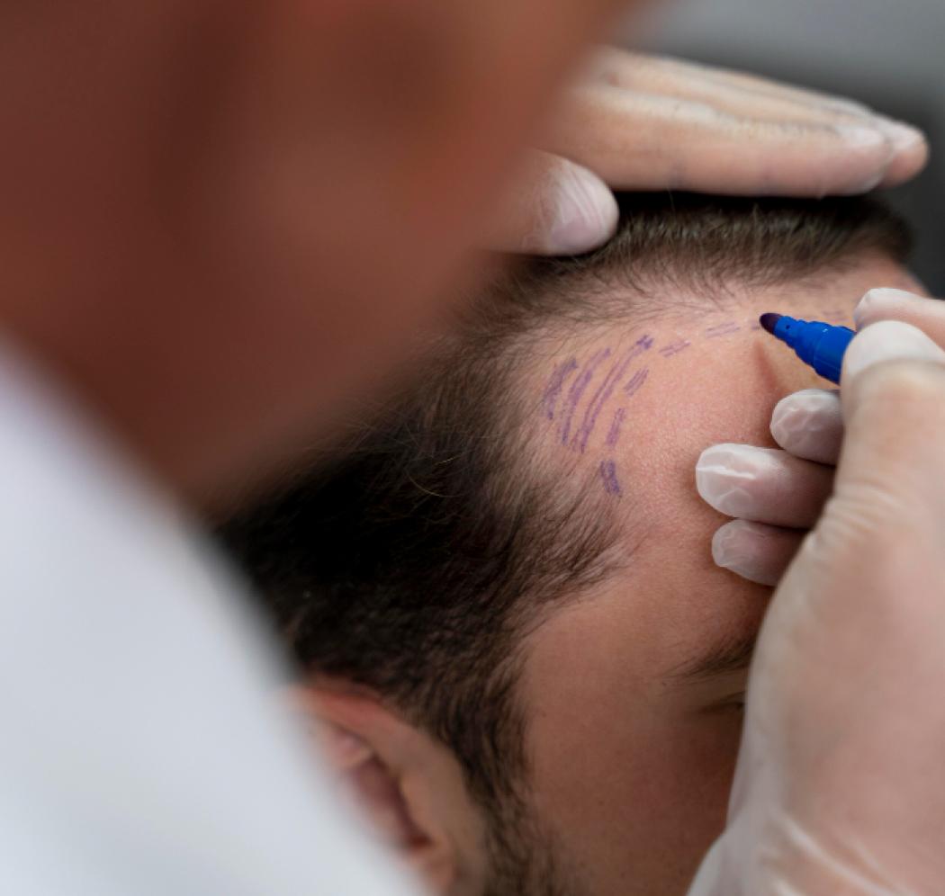 Hair Implant
