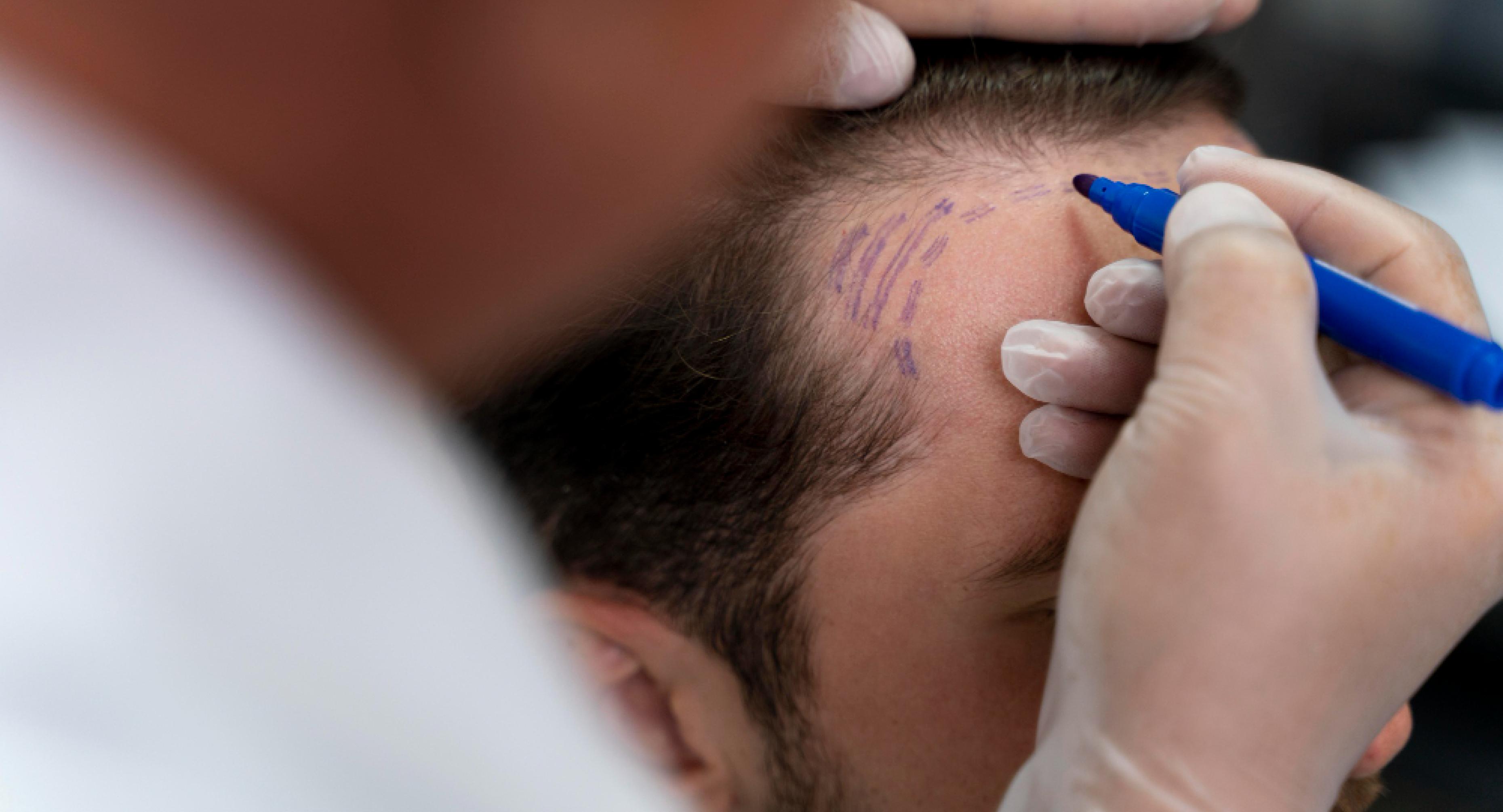 Hair Implant