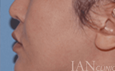 시술 후 이미지