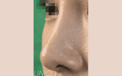 시술 후 이미지