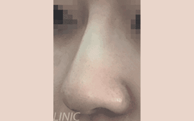 시술 후 이미지