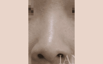 시술 전 이미지