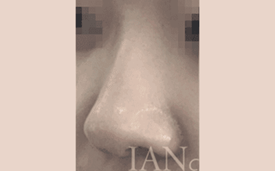 시술 전 이미지