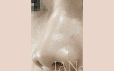 시술 전 이미지