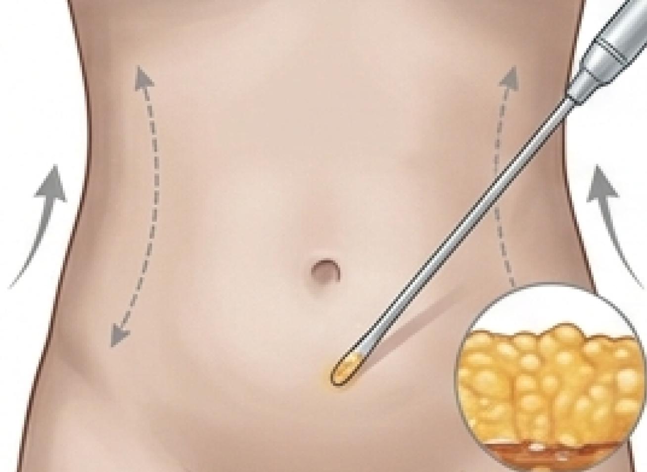 Liposuction