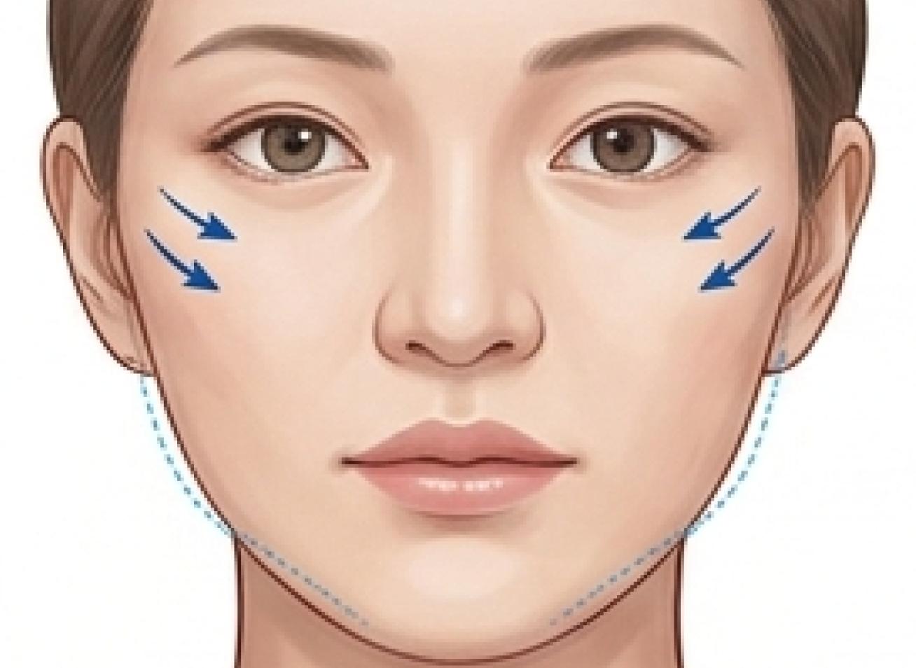 Cheekbone Reduction Surgery