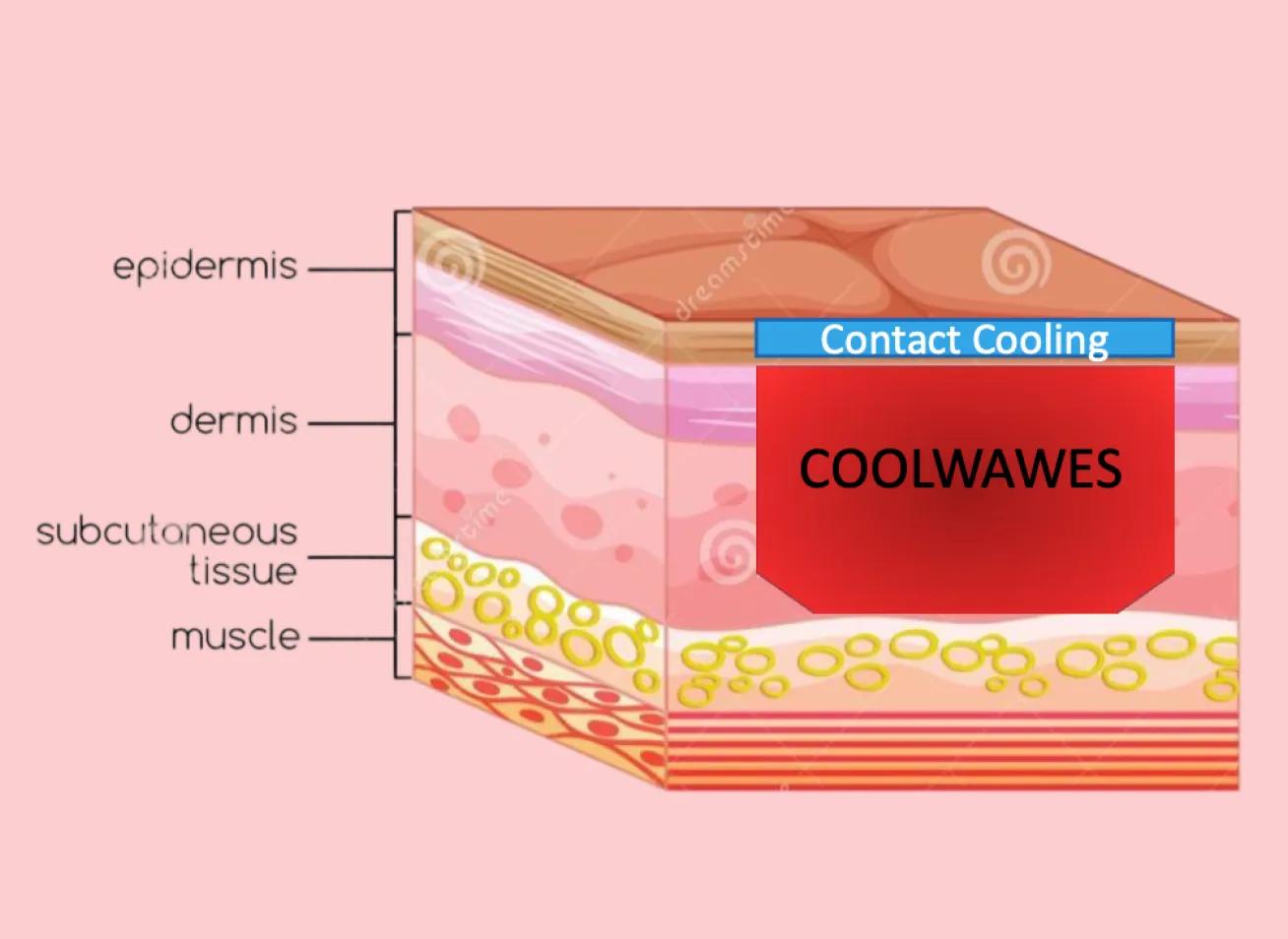 Patented ‘Coolwaves™’ Technology