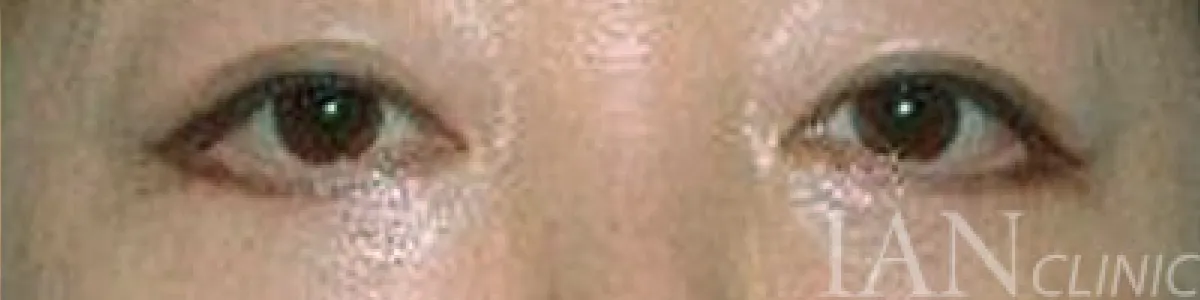 시술 후 이미지