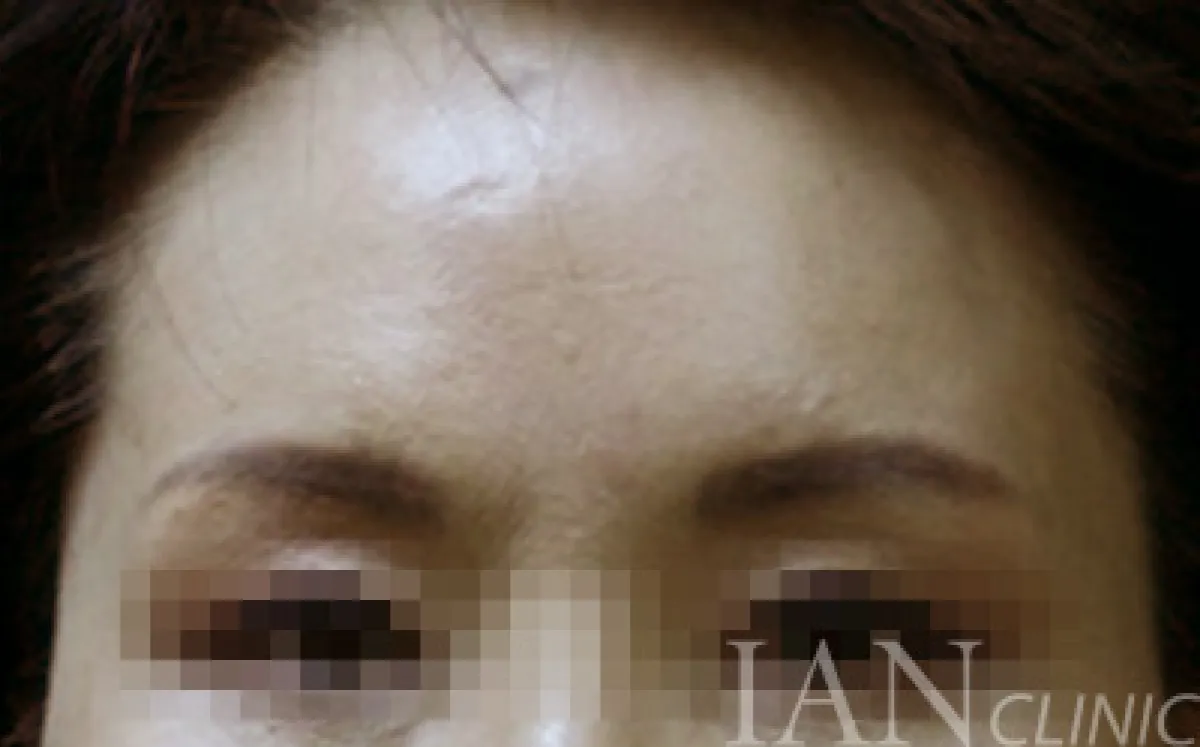 시술 후 이미지