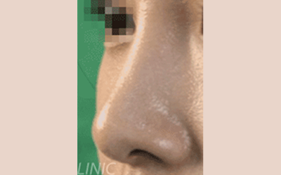 시술 후 이미지