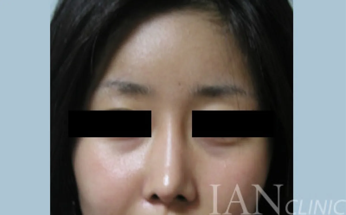 시술 후 이미지