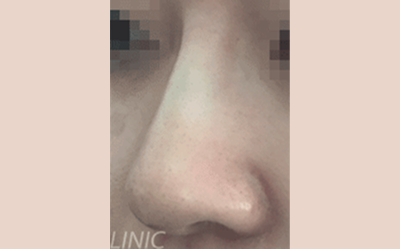 시술 후 이미지