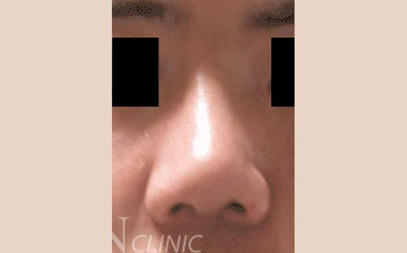 시술 후 이미지
