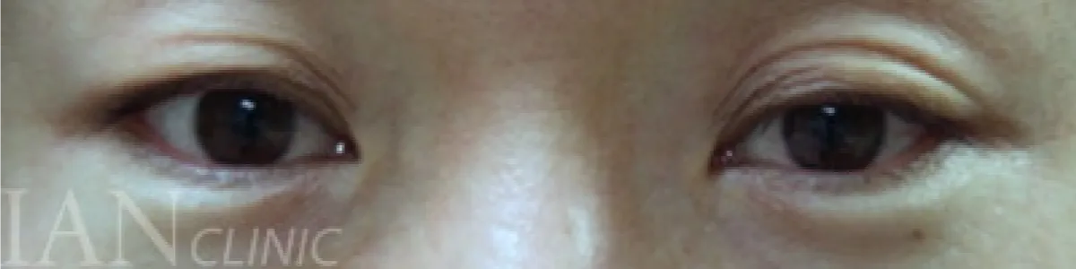 시술 전 이미지