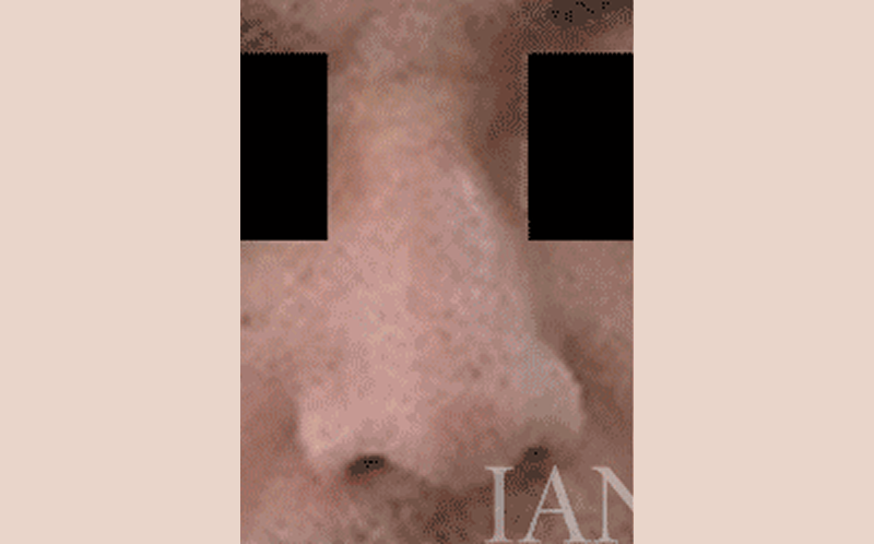 시술 전 이미지