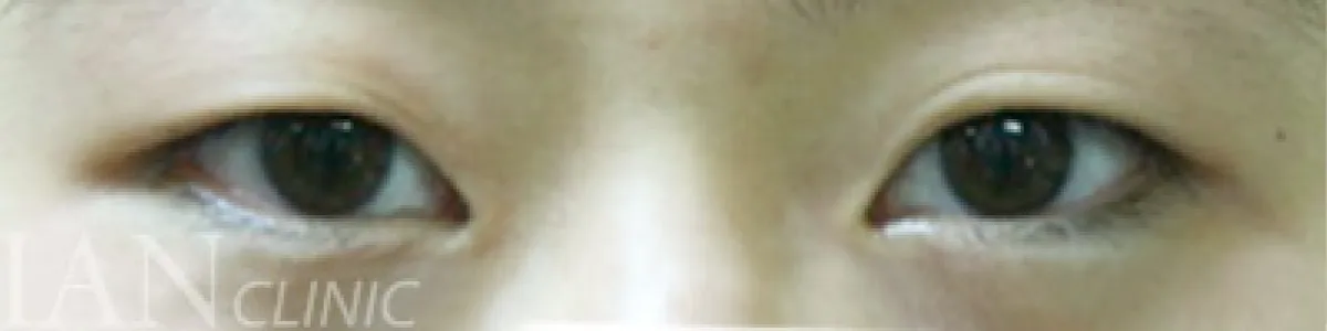 시술 전 이미지