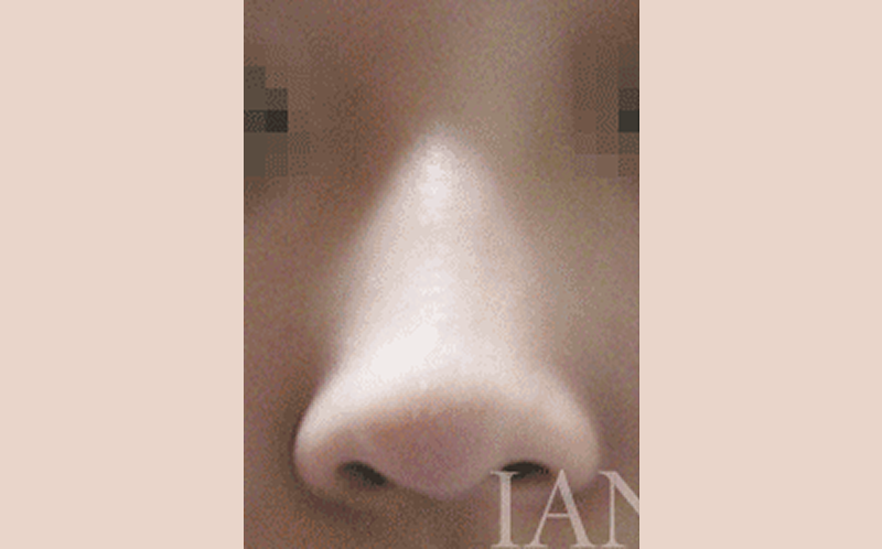 시술 전 이미지