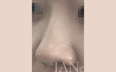 시술 전 이미지