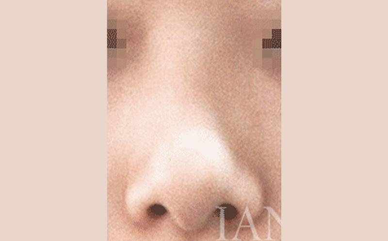 시술 전 이미지